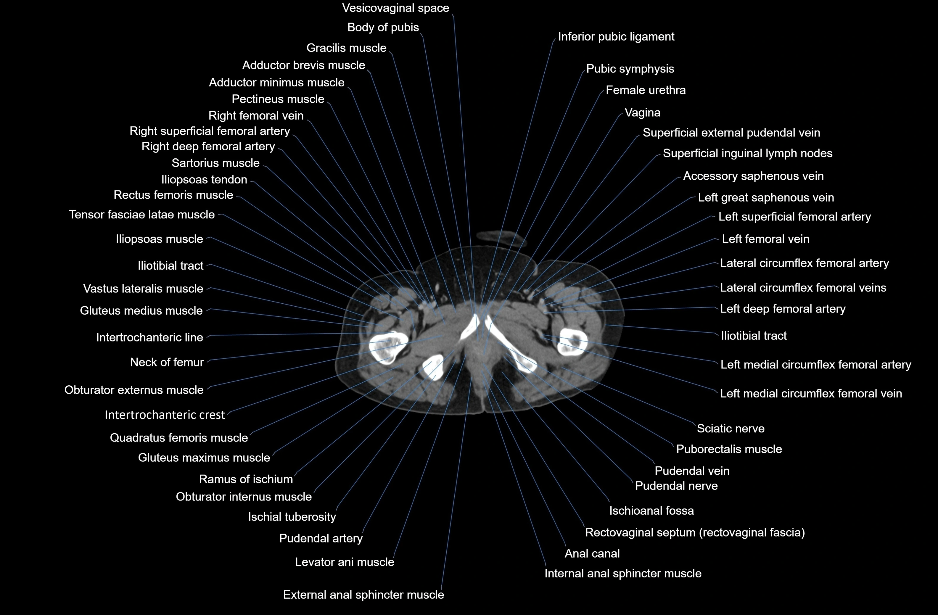 CT Abdomen axial cross sectional anatomy labelled radiology image-00102.webp